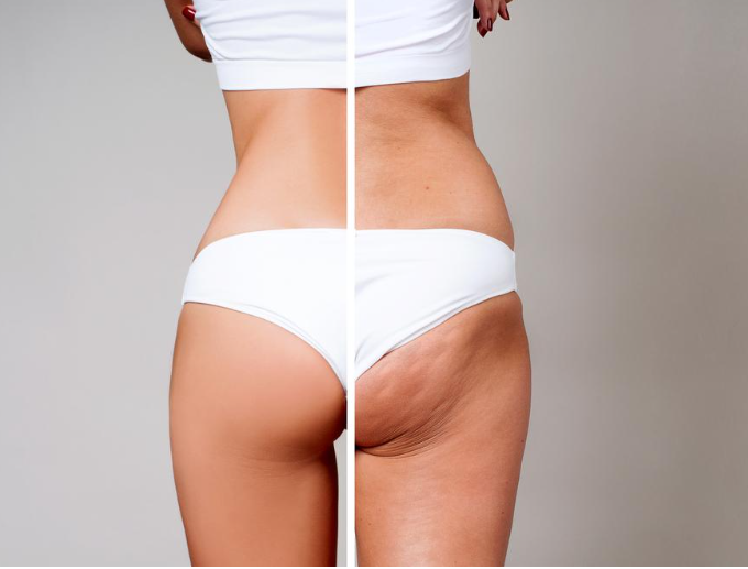 Box Trattamento Cellulite Completo